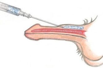 Un metodo pericoloso per l'ingrandimento del pene mediante iniezioni di vaselina